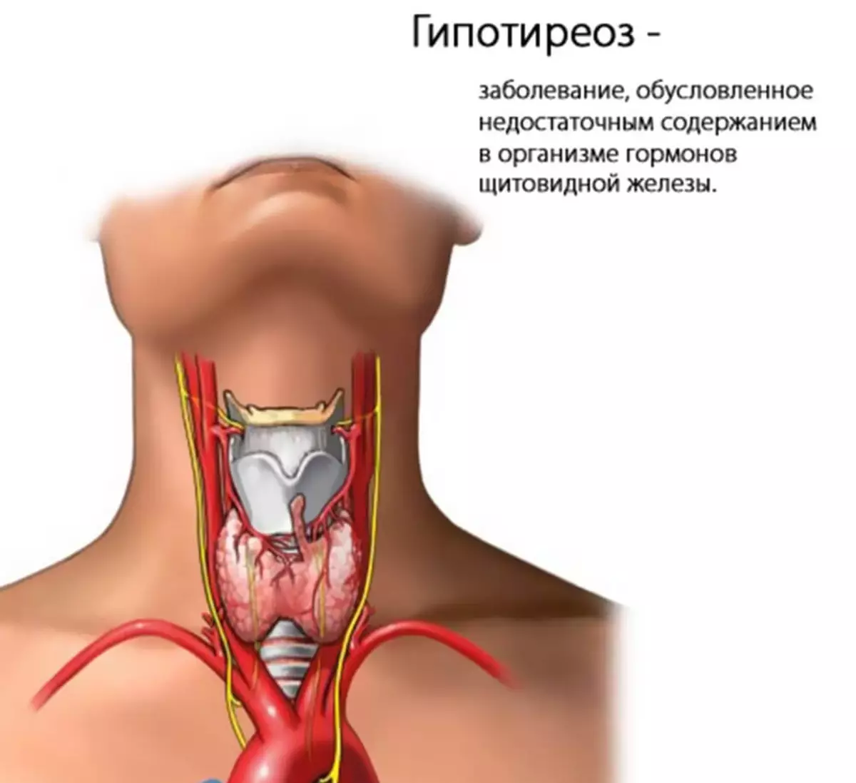 Что такое гипотиреоз?